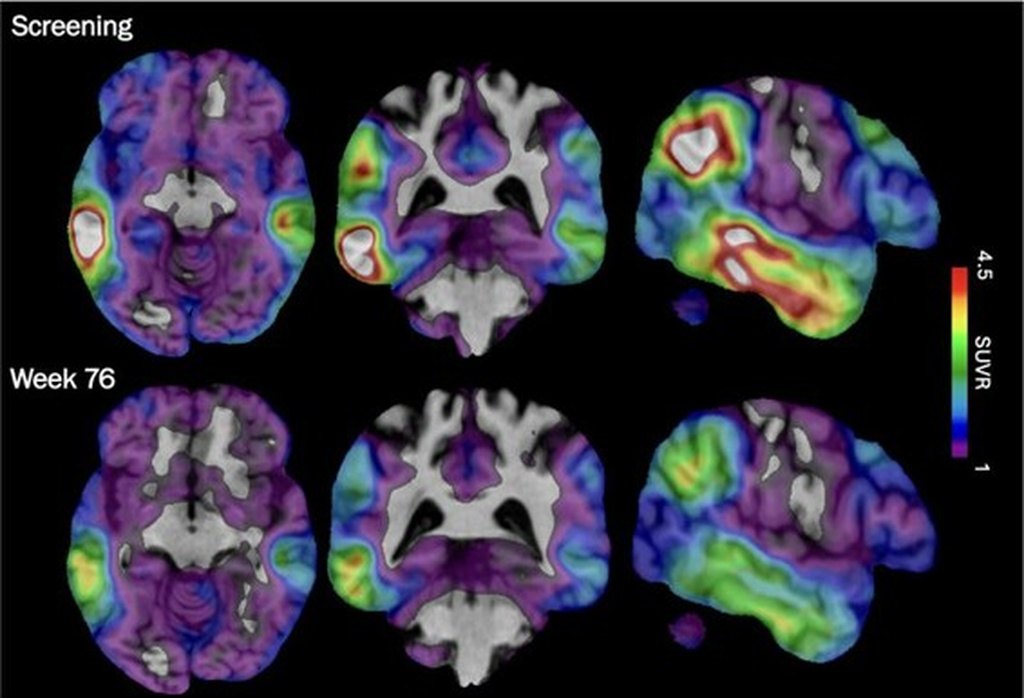 An experimental Alzheimer’s drug shows some promise as researchers hunt new approaches An experimental Alzheimer’s drug shows some promise as researchers hunt new approaches