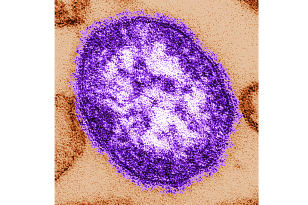 Pennsylvania reports first 2 measles deaths in the US this year, both people unvaccinated