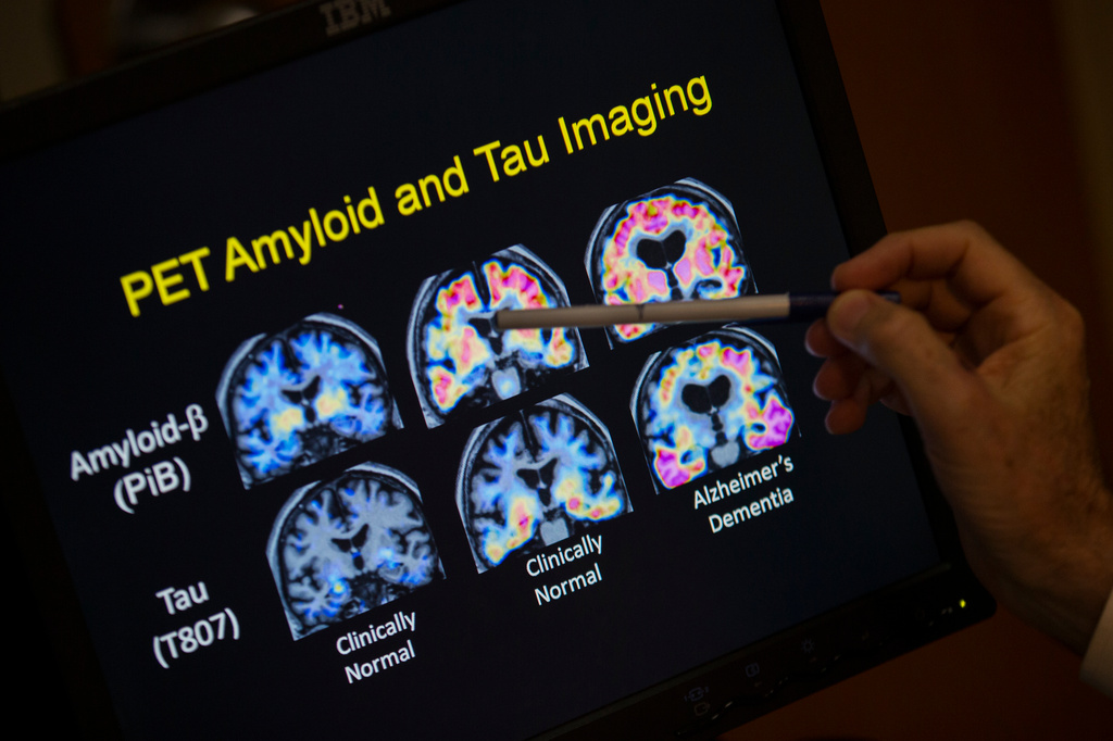 Want to lower your risk of dementia? It doesn’t involve a blood test